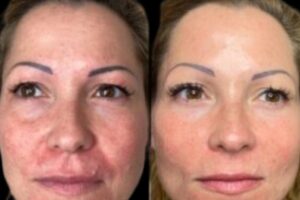 Profhilo treatments in dubai