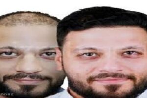 زراعة الشعر في الرياض