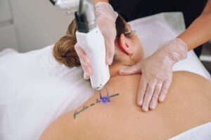 Laser Tattoo removal in Dubai