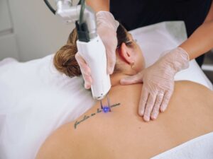 Laser Tattoo removal in Dubai