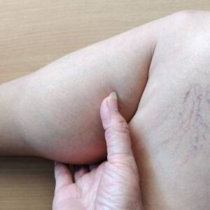 How Varicose Veins Treatment Revives Skin Tone