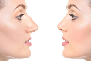 Rhinoplasty in Dubai