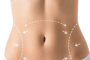 Tummy Tuck in Riyadh
