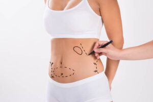 What Makes Tummy Tuck Ideal for Loose Belly Issues