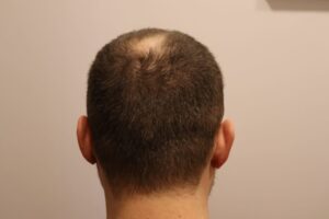 Why Crown Hair Transplant Works for Mature Hairlines