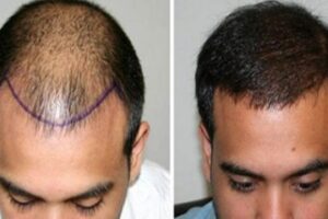 زراعة الشعر في الرياض