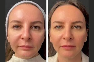 How Long Do Mesotherapy treatment in Dubai Results Last ?