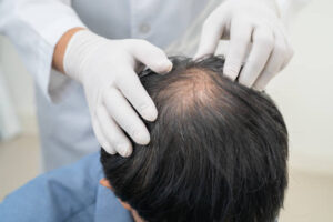 Alopecia Treatment in Islamabad