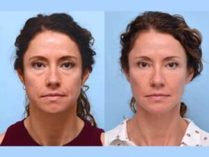 Thread Lift Treatment in Dubai: Fast Anti-Aging Results With Minimal Downtime