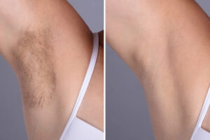 Laser hair removal in Dubai