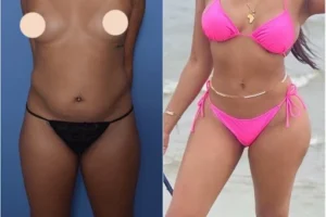 J-Plasma treatment in Dubai